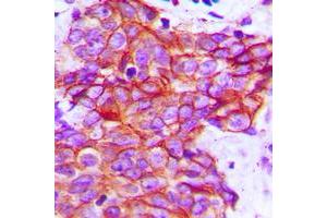 Immunohistochemical analysis of Claudin 5 staining in human breast cancer formalin fixed paraffin embedded tissue section. (Claudin 5 Antikörper  (C-Term))