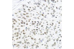 Immunohistochemistry of paraffin-embedded human lung cancer using GTF2B Rabbit pAb (ABIN7267370) at dilution of 1:100 (40x lens).