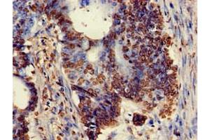 Immunohistochemistry of paraffin-embedded human colon cancer using ABIN7175897 at dilution of 1:100 (XRCC5 Antikörper  (AA 251-455))