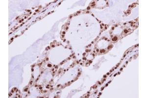 IHC-P Image Immunohistochemical analysis of paraffin-embedded human ovarian cancer, using RAD23B, antibody at 1:250 dilution. (RAD23B Antikörper  (Center))