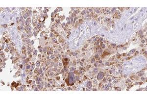 ABIN6273235 at 1/100 staining Human Melanoma tissue by IHC-P. (EGFL7 Antikörper  (Internal Region))