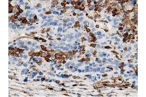 Immunohistochemical staining of paraffin-embedded Adenocarcinoma of Human colon tissue using anti-ARHGAP25 mouse monoclonal antibody. (ARHGAP25 Antikörper)