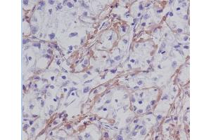 Immunohistochemical analysis of paraffin-embedded human liver cancer, using Fibronectin Antibody. (Rekombinanter Fibronectin Antikörper)