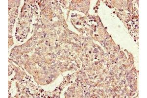 Immunohistochemistry of paraffin-embedded human cervical cancer using ABIN7167815 at dilution of 1:100 (Retinoid X Receptor gamma Antikörper  (AA 13-133))