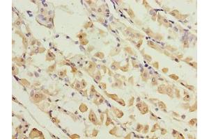 Immunohistochemistry of paraffin-embedded human gastric cancer using ABIN7157640 at dilution of 1:100 (KIF26B Antikörper  (AA 8-133))