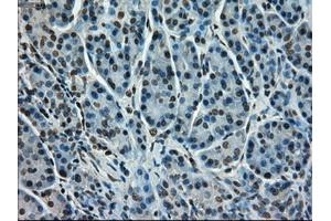 Immunohistochemical staining of paraffin-embedded Adenocarcinoma of colon tissue using anti-STK39mouse monoclonal antibody. (STK39 Antikörper)