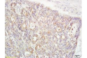 Formalin-fixed and paraffin embedded human rectal carcinoma labeled with Anti-RanBP1 Polyclonal Antibody, Unconjugated (ABIN1387616) at 1:200 followed by conjugation to the secondary antibody and DAB staining (RANBP1 Antikörper  (AA 86-116))