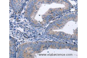 Immunohistochemistry of Human thyroid cancer using BDNF Polyclonal Antibody at dilution of 1:40 (BDNF Antikörper)