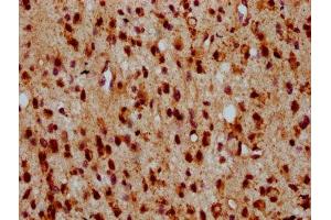IHC image of ABIN7155865 diluted at 1:500 and staining in paraffin-embedded human glioma performed on a Leica BondTM system.