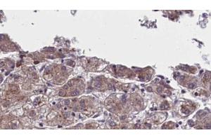 ABIN6273960 at 1/100 staining Human liver cancer tissue by IHC-P. (OR5AN1 Antikörper  (Internal Region))