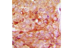 Immunohistochemical analysis of MMP11 staining in human breast cancer formalin fixed paraffin embedded tissue section. (MMP11 Antikörper  (Center))