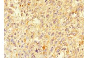 Immunohistochemistry of paraffin-embedded human melanoma using ABIN7160214 at dilution of 1:100