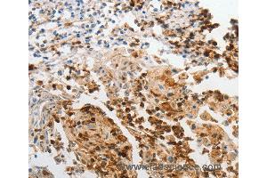 Immunohistochemistry of Human cervical cancer using LCN2 Polyclonal Antibody at dilution of 1:60 (Lipocalin 2 Antikörper)