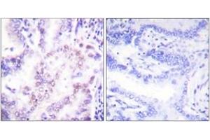 Immunohistochemistry analysis of paraffin-embedded human lung carcinoma tissue, using Thyroid Hormone Receptor beta Antibody. (THRB Antikörper  (AA 11-60))