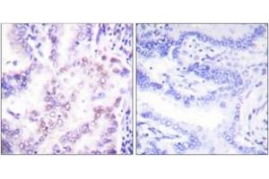 Immunohistochemistry analysis of paraffin-embedded human lung carcinoma tissue, using Thyroid Hormone Receptor beta Antibody.