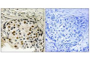 Immunohistochemistry analysis of paraffin-embedded human breast carcinoma tissue using OSR1 (Phospho-Thr185) antibody. (OSR1 Antikörper  (pThr185))