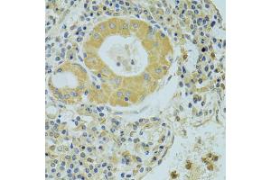 Immunohistochemistry of paraffin-embedded human lung cancer using PECR antibody (ABIN2564466) at dilution of 1:100 (40x lens). (PECR Antikörper)