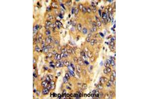 Formalin-fixed and paraffin-embedded human hepatocarcinoma with MSRB2 Antibody (Center), which was peroxidase-conjugated to the secondary antibody, followed by DAB staining. (MSRB2 Antikörper  (Middle Region))