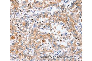 Immunohistochemistry of Human liver cancer using PPOX Polyclonal Antibody at dilution of 1:40