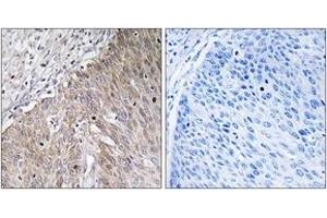 Immunohistochemistry analysis of paraffin-embedded human cervix carcinoma tissue, using APOL2 Antibody. (Apolipoprotein L 2 Antikörper  (AA 191-240))