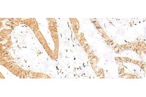 Immunohistochemistry of paraffin-embedded Human liver cancer tissue using HES7 Polyclonal Antibody at dilution of 1:25(x200) (HES7 Antikörper)