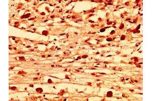 IHC image of ABIN7158070 diluted at 1:300 and staining in paraffin-embedded human melanoma performed on a Leica BondTM system. (LRRFIP2 Antikörper  (AA 211-342))