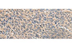 Immunohistochemistry of paraffin-embedded Human cervical cancer tissue using RPS14 Polyclonal Antibody at dilution of 1:50(x200) (RPS14 Antikörper)