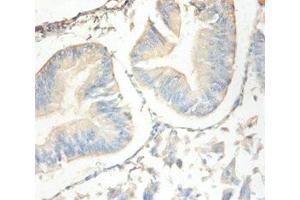 Immunohistochemistry of paraffin-embedded human endometrial cancer using ABIN7144333 at dilution of 1:100 (SLPI Antikörper  (AA 26-132))
