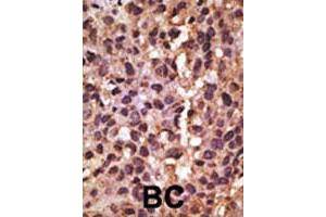 Formalin-fixed and paraffin-embedded human breast cancer tissue reacted with BNIP3 polyclonal antibody  , which was peroxidase-conjugated to the secondary antibody, followed by DAB staining. (BNIP3 Antikörper  (AA 215-252))
