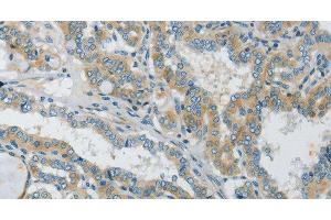 Immunohistochemistry of paraffin-embedded Human thyroid cancer tissue using Connexin-45 Polyclonal Antibody at dilution 1:50 (GJC1 Antikörper)