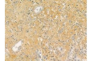 ABIN6264645 and ABIN6276782 at 1/100 staining human gastric carcinoma by IHC-P.