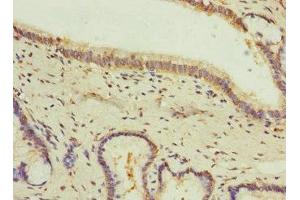 Immunohistochemistry of paraffin-embedded human prostate cancer using ABIN7153669 at dilution of 1:100 (GIPR Antikörper  (AA 22-138))