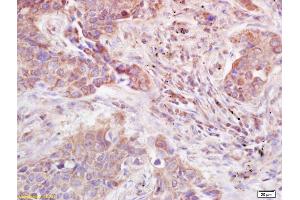 Formalin-fixed and paraffin embedded human lung carcinoma labeled with Anti-ADAMTS12 Polyclonal Antibody, Unconjugated (ABIN685792) at 1:200 followed by conjugation to the secondary antibody and DAB staining. (ADAMTS12 Antikörper  (AA 301-450))