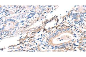 Immunohistochemistry of paraffin-embedded Human gastric cancer using TWF2 Polyclonal Antibody at dilution of 1:40 (TWF2 Antikörper)