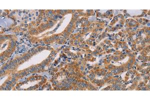 Immunohistochemistry of paraffin-embedded Human thyroid cancer tissue using CDK11A/B Polyclonal Antibody at dilution 1:50 (Cdk11A/B Antikörper)