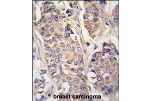 Formalin-fixed and paraffin-embedded human breast carcinoma tissue reacted with ACO2 antibody , which was peroxidase-conjugated to the secondary antibody, followed by DAB staining. (ACO2 Antikörper  (AA 294-325))