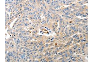 The image on the left is immunohistochemistry of paraffin-embedded Human ovarian cancer tissue using ABIN7190149(CD93 Antibody) at dilution 1/60, on the right is treated with synthetic peptide. (CD93 Antikörper)