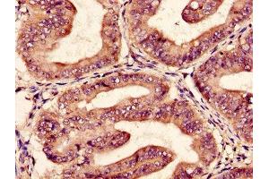 Immunohistochemistry of paraffin-embedded human endometrial cancer using ABIN7152013 at dilution of 1:100