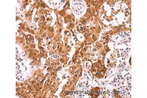 Immunohistochemistry of Human lung cancer using NCEH1 Polyclonal Antibody at dilution of 1:80 (NCEH1 Antikörper)