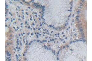 DAB staining on IHC-P; Samples: Human Stomach cancer Tissue (Growth Hormone 2 Antikörper  (AA 27-217))