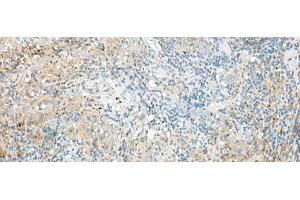 Immunohistochemistry of paraffin-embedded Human cervical cancer tissue using RPP14 Polyclonal Antibody at dilution of 1:60(x200) (RPP14 Antikörper)