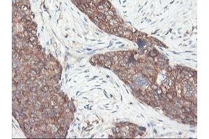 Immunohistochemical staining of paraffin-embedded Adenocarcinoma of Human breast tissue using anti-PFKP mouse monoclonal antibody. (PFKP Antikörper)
