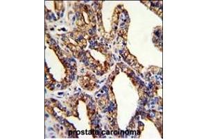 Formalin-fixed and paraffin-embedded human prostate carcinoma with TROP2 Antibody (Center), which was peroxidase-conjugated to the secondary antibody, followed by DAB staining. (TACSTD2 Antikörper  (AA 162-190))
