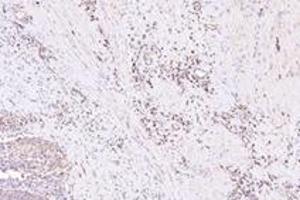 Immunohistochemistry analysis of paraffin-embedded human bladder cancer using NXF2 (ABIN7074901) at dilution of 1: 3000