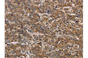 The image on the left is immunohistochemistry of paraffin-embedded Human liver cancer tissue using ABIN7192097(RAB22A Antibody) at dilution 1/20, on the right is treated with synthetic peptide. (RAB22A Antikörper)