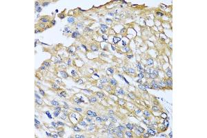 Immunohistochemistry of paraffin-embedded human prostate cancer using CCL8 antibody (ABIN5975074) at dilution of 1/100 (40x lens). (CCL8 Antikörper)