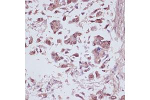 Immunohistochemistry of paraffin-embedded human lung cancer using U2 antibody (ABIN6134442, ABIN6149752, ABIN6149755 and ABIN6217061) at dilution of 1:100 (40x lens). (U2AF1 Antikörper  (AA 1-100))