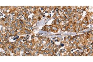 Immunohistochemistry of paraffin-embedded Human breast cancer using PPOX Polyclonal Antibody at dilution of 1:40 (PPOX Antikörper)