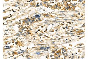 ABIN6262457 and ABIN6278271 at 1/100 staining Human gastric cancer by IHC-P. (IFITM3 Antikörper  (N-Term))