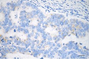 Immunohistochemistry was performed on paraffin-embedded human sigmoid colon carcinoma using TNF receptor associated protein 1 antibody (ABIN7800567), 1:200). (Rekombinanter TRAP1 Antikörper)
